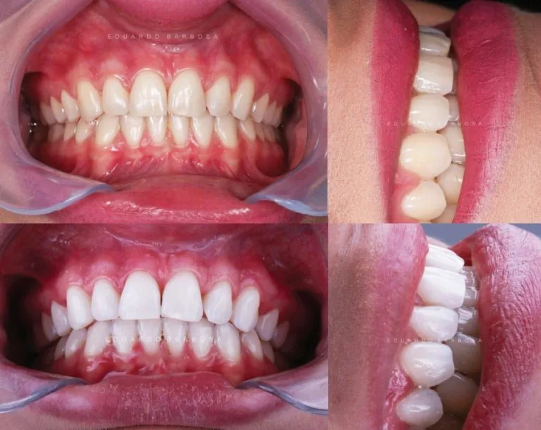 Fotografias de arcadas dentárias antes e depois de um tratamento.